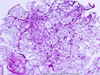 Candidose de muqueuse oesophagienne
