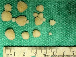 Des calculs rnaux sont des cristaux d'oxalate de calcium