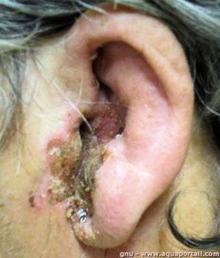 otite externe
