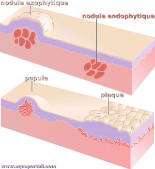 nodule