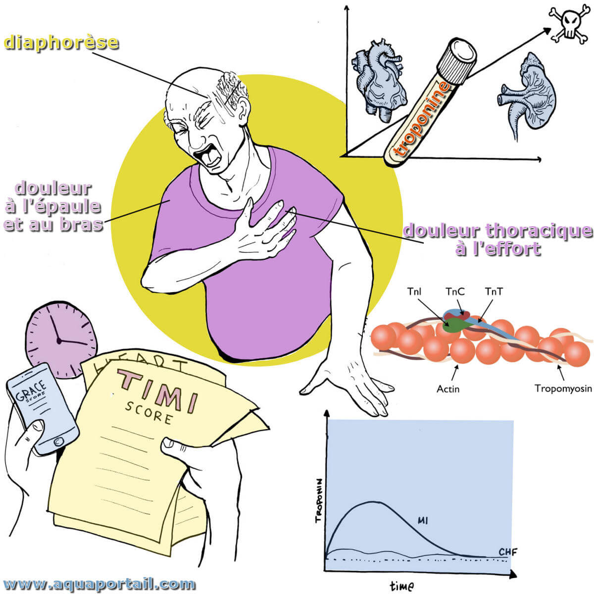 Troponine D finition Et Explications