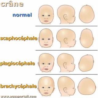 brachycphalie