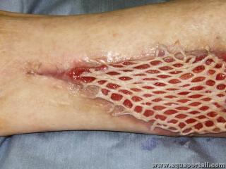 Greffon de peau sur le bras d'un homme