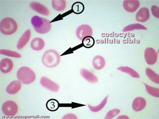 Codocyte (cellule cible) parmi des globules rouges