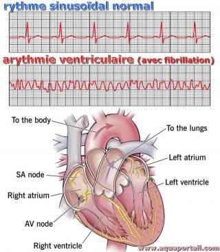 arythmie