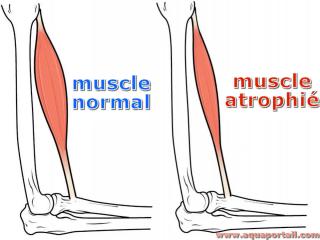 Atrophie musculaire : comparaison muscle normal vs. muscle atrophi