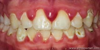 dcalcification