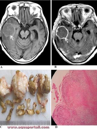 tuberculome