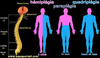 Hmiplgie, paraplgie et quadriplgie