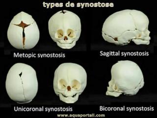 synostose
