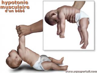 Hypotonie musculaire d'un bb