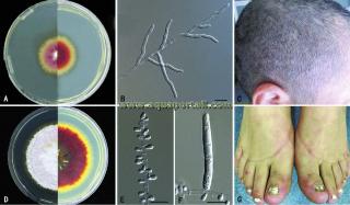 Phnotypes de deux dermatophytes anthropophiles