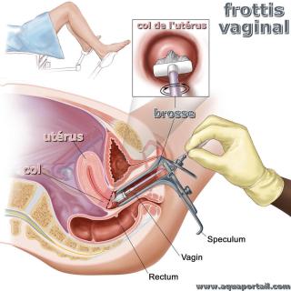 frottis