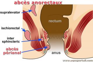Photo de prianal et ses synonymes. Types d'abcs anorectaux, dont l'abcs prianal