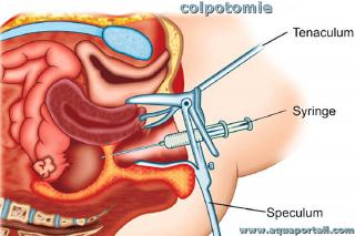 colpotomie