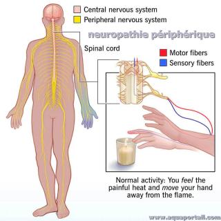 Neuropathie priphrique