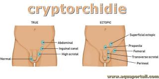 cryptorchidie