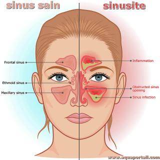 sinus