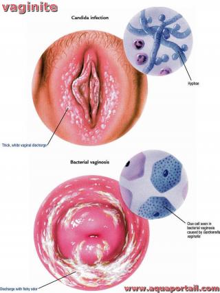 Vaginite