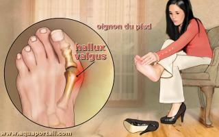 hallux valgus
