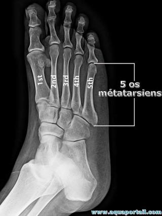 Radiographie des 5 os mtatarsiens