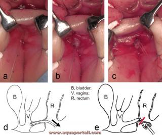 Fistule dans le rectum et trajet fistuleux