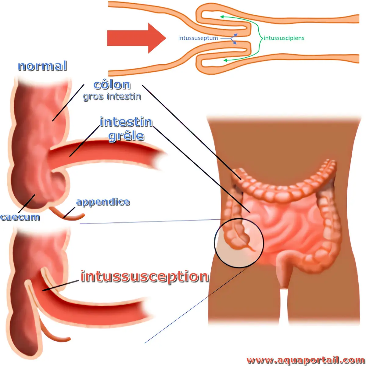 intussusception